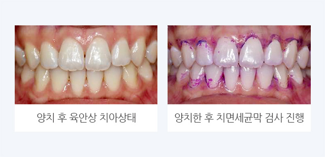 양치 후 육안상 치아 상태 / 양치한 후 치면세균막 검사 진행